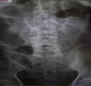 Simple abdominal X-ray showing intestinal distension without hydro-aerial levels and distal air in the rectum.