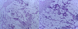 Presence of omental adenocarcinoma. Haematoxylin–eosin staining.