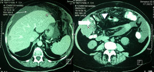 Abdominal tomography that shows ascites (thin arrow), as well as a tumour in the right flank, that compresses the right colon (thick arrow), these data are an indication of carcinomatosis (arrow head).