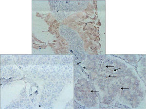 Immunohistochemistry. The use of this technique is shown in the ovarian tumour (upper image), as well as in the adenocarcinoma area of the metastasis (lower right) with negative receptors, and the positive receptors to oestrogens in the sarcomatous area of the metastasis.