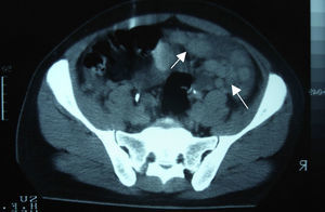 Pelvic computed tomography. Presence of multiple nodules of variable shape and size (arrows).