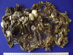 Omentum of 52cm×22cm×7cm, with multiple nodular to ovoid lesions of different sizes. The largest lesion had a major diameter of 6cm, and a lobulated and whitish surface.