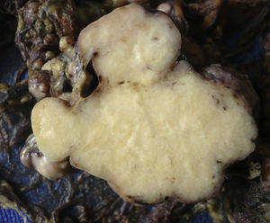 Cut surface. A solid tumour with lobulated borders and homogeneous white colour is observed.