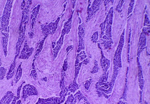 Microphotography, 4×. Tumour is made up of neoplastic cells arranged in cords and nests, separated by desmoplastic fibrous connective tissue.