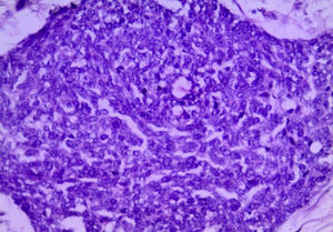 Microphotography, 10×. This shows a nest of small, round, blue cells with little cytoplasm, round-to-oval nucleus with fragmented chromatin, small number of mitosis with peripheral foci. An image of a picket-fence form and rosette formation is observed.