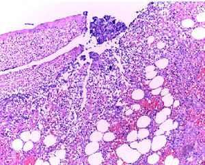 The histopathological study: 100× haematoxylin and eosin staining, connective tissue composed of spindle cells with ample, eosinophilic cytoplasm, with round and oval nuclei without atypia, consistent with the diagnosis of mesenteric pseudocyst.