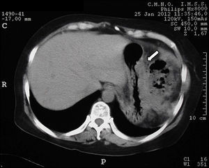 Computed axial tomography scan showing xanthogranulomatous process in greater curvature of the stomach.