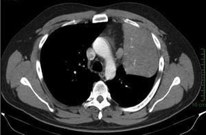 Axial contrast computerised tomography scan showing a lesion of approximately 4cm×4cm×3.5cm in upper left lobe, located predominantly at hilum level, and distal obstructive pneumonia.