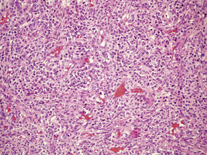 Neoplasia comprised by uniform cells with abundant cytoplasm, and round, regular nucleus with no significant pleomorphism. The distribution pattern around the blood vessels with thin walls, discretely ramified, is clear. HE, 200×.
