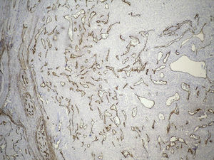 CD34 staining highlights the numerous vessels that are present in the lesion. HE, 40×.