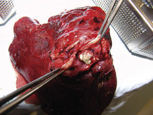 In the specimen from the upper left lobectomy, a well-defined, cream-coloured 3cm×2cm×1cm nodule with haemorrhagic areas was found 0.5cm from the bronchial margin.