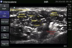 Ultrasound of the brachial plexus at the interscalene level.