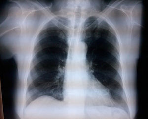Post-bilateral interscalene block chest X-ray (case 1) where the hemidiaphragms are not affected, indicating there was no phrenic nerve block on either side (the plate was taken at the end of surgery).