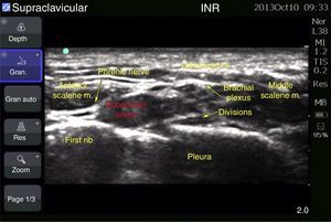 Brachial plexus ultrasound at supraclavicular level.