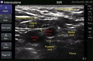 Brachial plexus ultrasound at infraclavicular level.