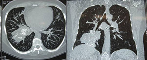 Thoracic CT scan, axial and coronal slices showing a hyperdense lesion with diffuse calcifications in its interior, in the anterior and lateral basal segments, in the lower right lung lobe.