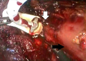 Laparoscopic extraction of the gastric band. Penetration site (white arrow), stomach (black arrow).