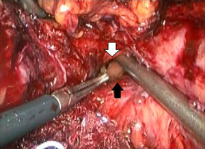 Gastric mucosa marked with a white arrow. The erosion diameter can be seen (black arrow, lower edge of erosion).