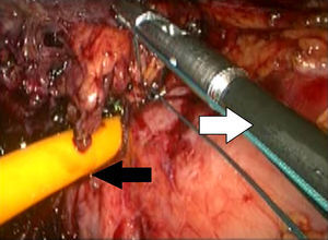Making the gastrostomy purse string ligature laparoscopically, knot pusher (white arrow), Foley catheter in erosion site (black arrow).