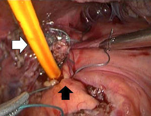 The completed procedure for placing the Foley catheter in the gastric band penetration site (white arrow) using intracorporeal knots (black arrow) if a knot pusher is not available.