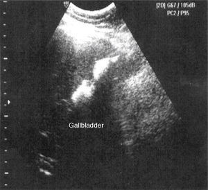 Ultrasound concluding a diagnosis of cholecystolithiasis.