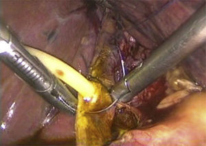 A #10 Fr T-tube placed in the choledocotomy site and fixed with Vicryl 4-0.