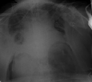 Chest X-ray. Air in the diaphragmatic cupulae compatible with the presence of a pneumothorax. No signs of pneumothorax, pneumomediastinum or subcutaneous emphysema could be seen.