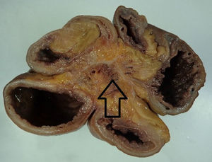 The arrow shows mesenteric fibrosis secondary to the desmoplastic reaction caused by the intestinal carcinoid.