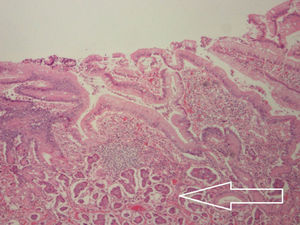 Group of cells corresponding to a grade 1 neuroendocrine neoplasia (carcinoid tumour) which is infiltrating the lamina propria, muscularis mucosae, submucosa, muscularis propria and serosa.