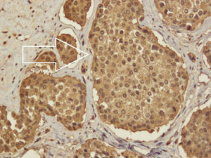 Diffuse positive for chromogranin A in neoplastic cells.