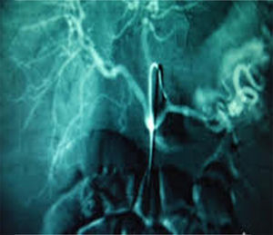Vascular rupture (splenic artery), which can be diagnosed by mesenteric arteriography.