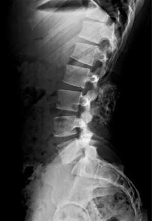 Lateral radiography of the lumbosacral column, showing a tumour of approximately 7cm.