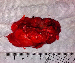 Pathology specimen. Osteosarcoma of 7cm×3cm×2cm.