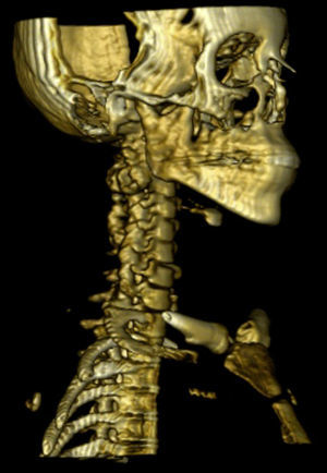 Computed axial tomography with bone reconstruction of the spinal column, showing a bone tumour at C2 level.