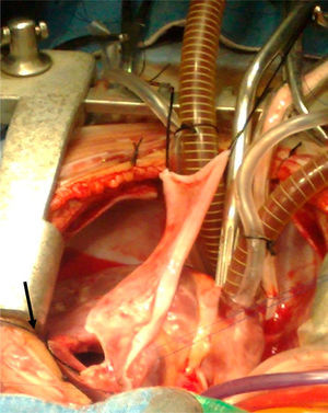 Placing a transannular patch with autologous pericardium (treated with 0.6% glutaraldehyde for 10min and washed with saline solution) with the smooth portion facing pulmonary flow.