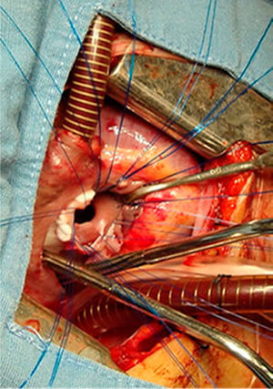 Transatrial approach for closure of interventricular communication.