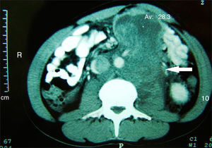 Computed tomography scan. A retroperitoneal tumor of 6cm×13cm is observed.