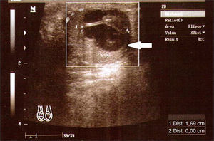 Ultrasound scan of the right testicle which shows a cystic fine-tissued tumor with irregular hypoechoic areas.