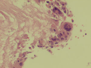 Biopsy of retroperitoneal tumor with extensive tumor necrosis and the presence of cyto-type and syncytiotrophoblast cell.