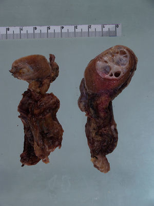 Bilateral orchiectomy specimen, showing the presence of heterogenous neoplasic nodes with small cystic cavities.