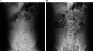Erect and decubitus plain X-ray of the abdomen show major dilation of small bowel loops, with straight forward obstructive pattern.