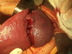 Devascularisation of the lower pole of the spleen with active bleeding at hilum level.