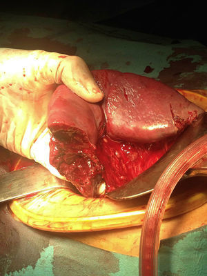Image of the spleen after completing partial resection of the lower pole.