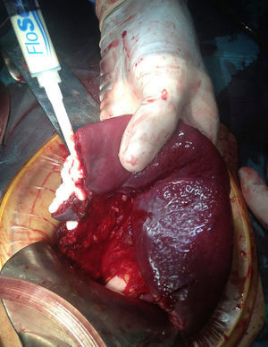 Application of haemostatic agent on the surface of the splenic resection and in a laceration of the upper splenic pole.