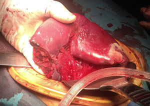 Total control of bleeding, with 75% viability of the remainder of the organ, which was decided to preserve.