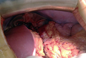 Intraoperative image on conclusion of procedure and availability of the remainder of the preserved organ in the splenic cell.