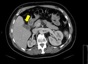 Abdominal computed tomography which showed: thrombosis of the left portal vein secondary to acute lithiasic cholycystitis (white arrow).