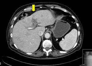 Abdominal computed tomography where the white arrow shows thrombosis of the left portal vein, secondary to acute lithiasic cholycystitis.