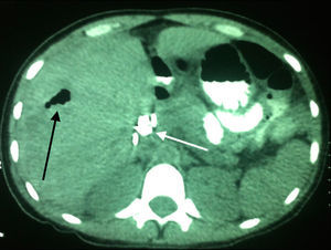 Contrast enhanced axial CT scan of the abdomen, with no presence of liver damage. Air in the intrahepatic biliary duct is observed (a common occurrence after endoscopic retrograde cholangiopancreatography) and the presence of stents in the extrahepatic biliary duct (black and white arrows respectively).