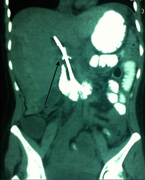 Contrast enhanced coronal abdominal CT scan; the presence of the stent in the extrahepatic biliary duct (black arrow) is observed, with no observation of liver damage.